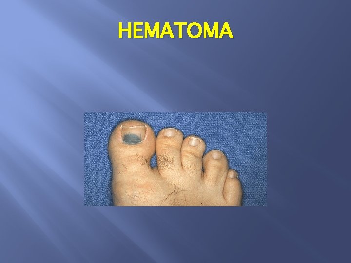 HEMATOMA 