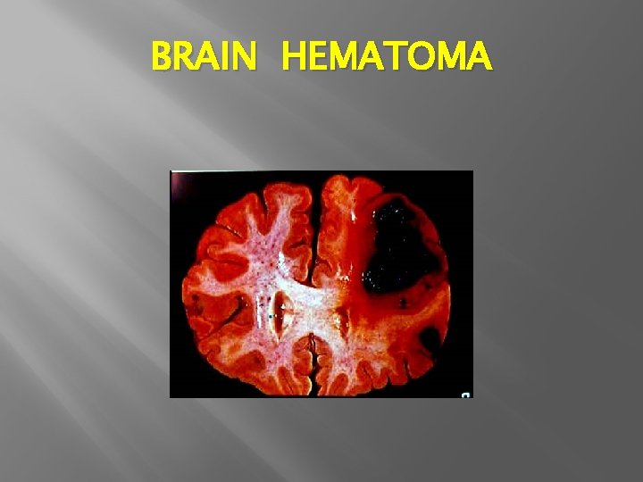 BRAIN HEMATOMA 