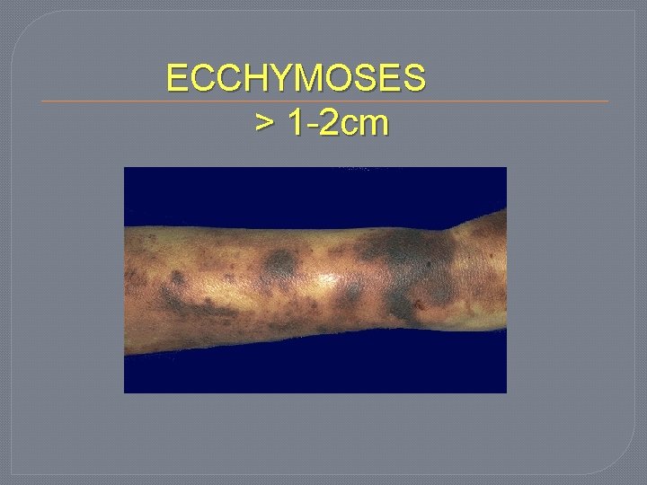 ECCHYMOSES > 1 -2 cm 