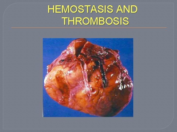 HEMOSTASIS AND THROMBOSIS 