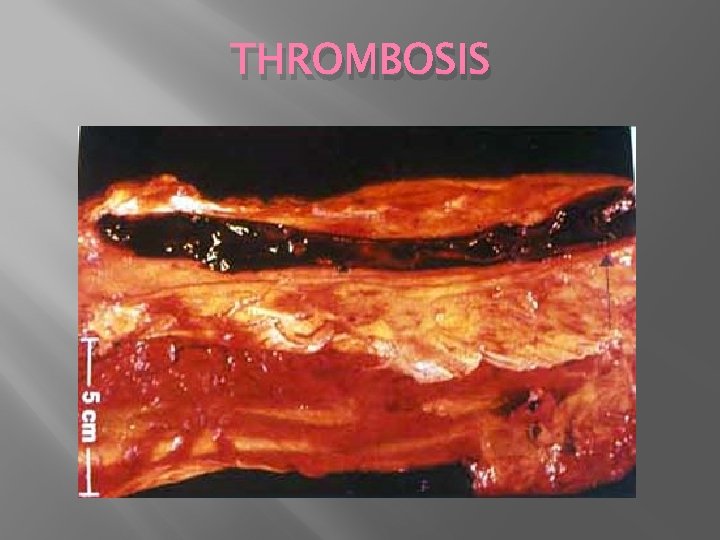 THROMBOSIS 