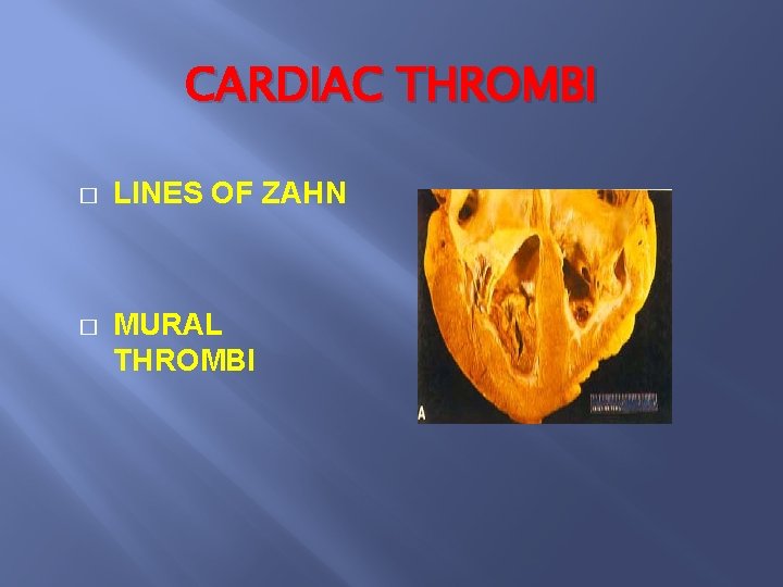 CARDIAC THROMBI � LINES OF ZAHN � MURAL THROMBI 