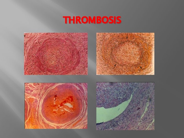 THROMBOSIS 