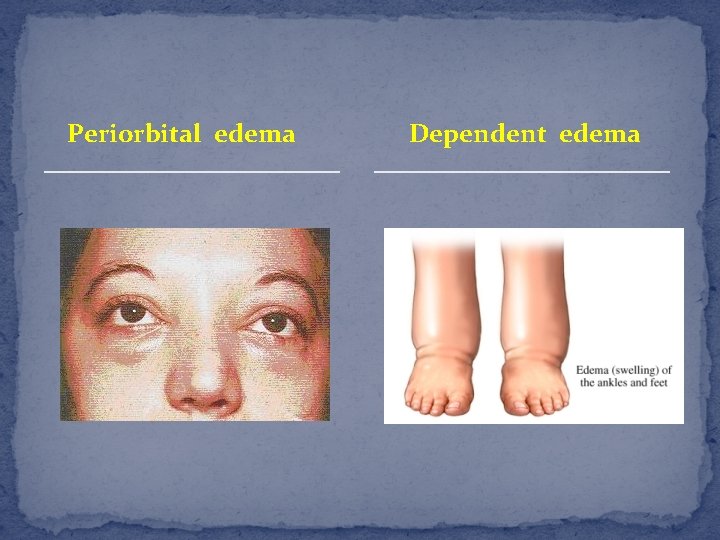 Periorbital edema Dependent edema 