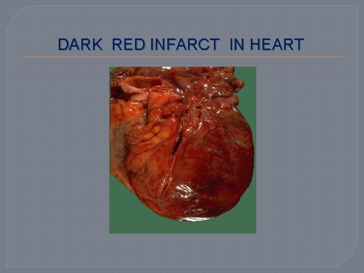 DARK RED INFARCT IN HEART 