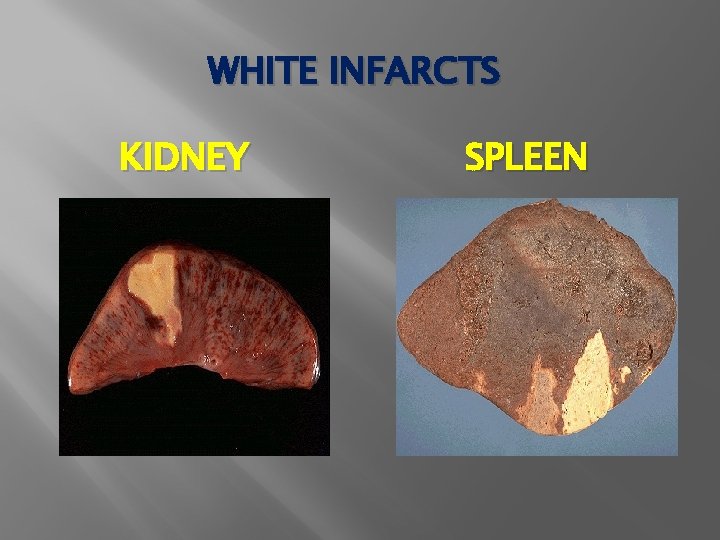 WHITE INFARCTS KIDNEY SPLEEN 
