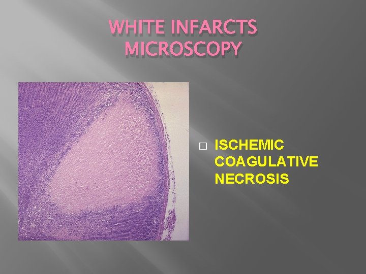WHITE INFARCTS MICROSCOPY � ISCHEMIC COAGULATIVE NECROSIS 