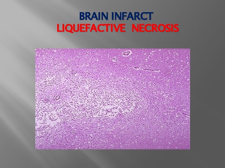 BRAIN INFARCT LIQUEFACTIVE NECROSIS 