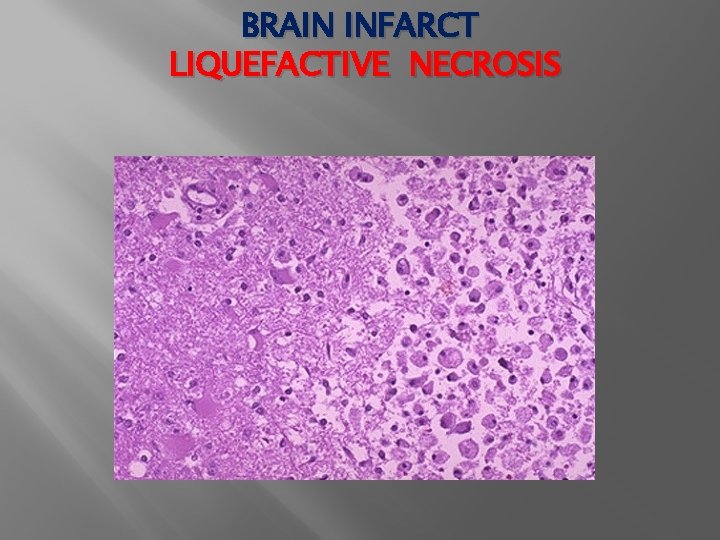 BRAIN INFARCT LIQUEFACTIVE NECROSIS 