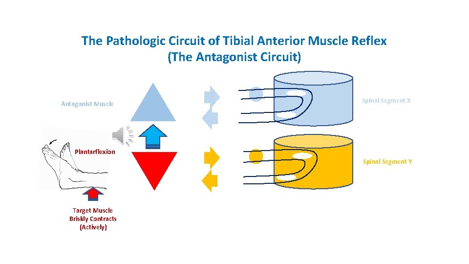 The Pathologic Circuit of Tibial Anterior Muscle Reflex (The Antagonist Circuit) Antagonist Muscle Spinal