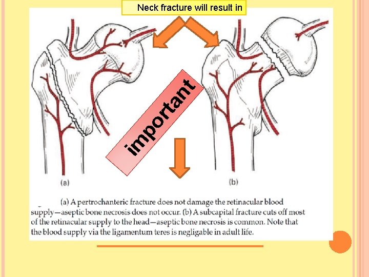 im po rta nt Neck fracture will result in 