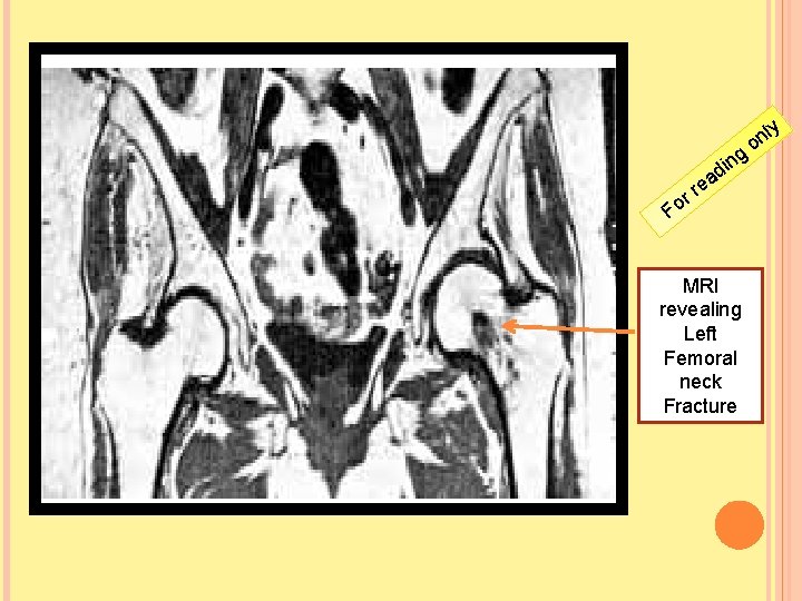 g n i d a e rr Fo MRI revealing Left Femoral neck Fracture
