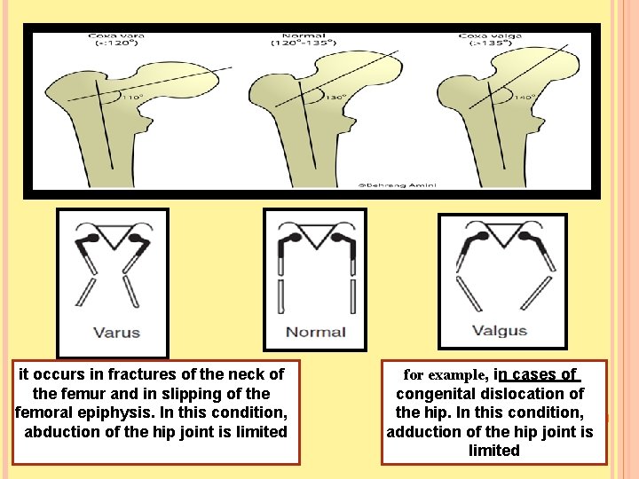 it occurs in fractures of the neck of the femur and in slipping of