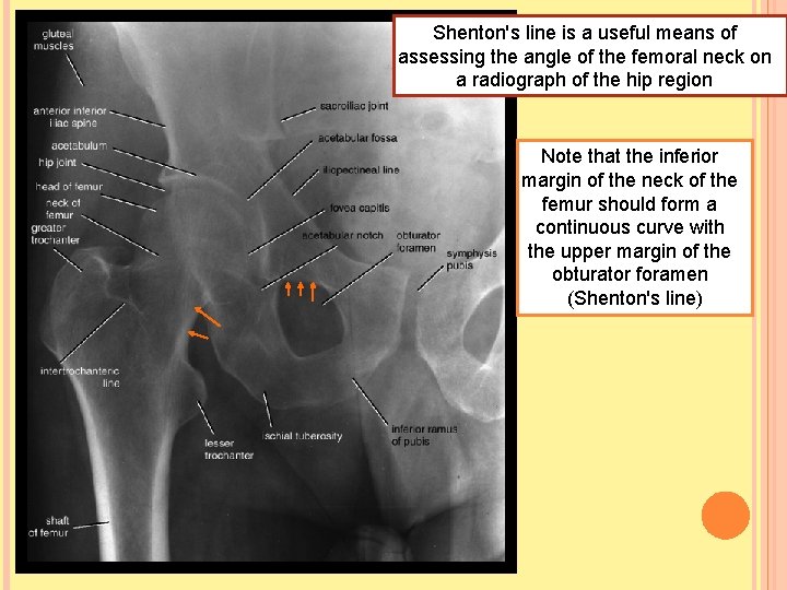Shenton's line is a useful means of assessing the angle of the femoral neck
