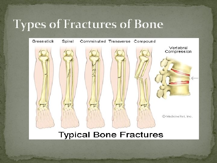 Types of Fractures of Bone  Types of Fractures of Bone