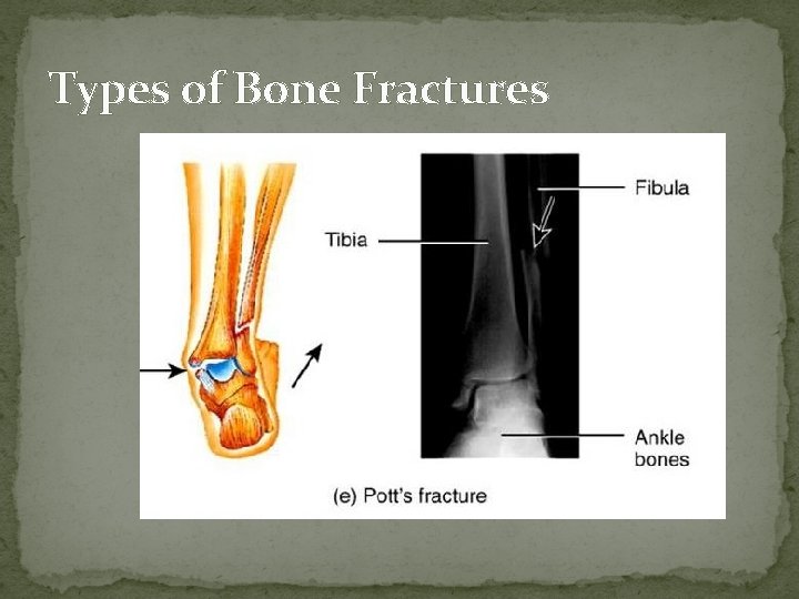 Types of Bone Fractures  Types of Bone Fractures