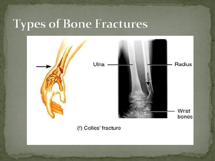 Types of Bone Fractures  Types of Bone Fractures