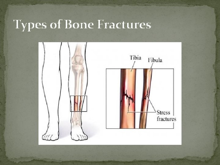 Types of Bone Fractures  Types of Bone Fractures