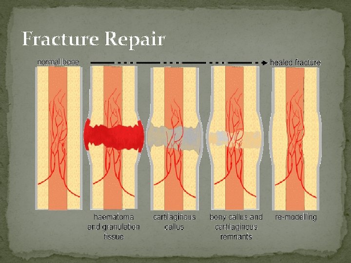 Fracture Repair  Fracture Repair
