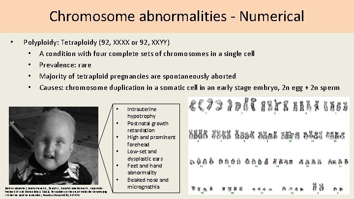 Chromosome abnormalities - Numerical • Polyploidy: Tetraploidy (92, XXXX or 92, XXYY) • A