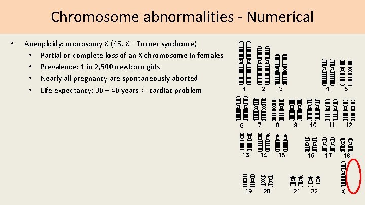 Chromosome abnormalities - Numerical • Aneuploidy: monosomy X (45, X – Turner syndrome) •