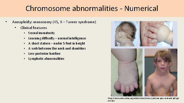 Chromosome abnormalities - Numerical • Aneuploidy: monosomy (45, X – Turner syndrome) • Clinical