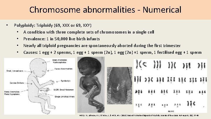 Chromosome abnormalities - Numerical • Polyploidy: Triploidy (69, XXX or 69, XXY) • A