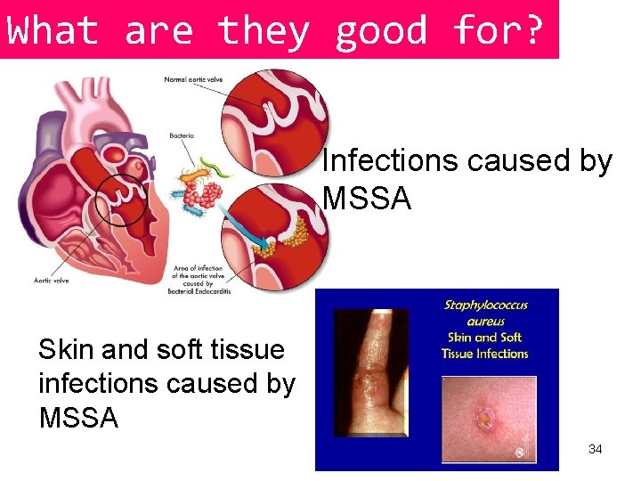 What are they good for? Infections caused by MSSA Skin and soft tissue infections