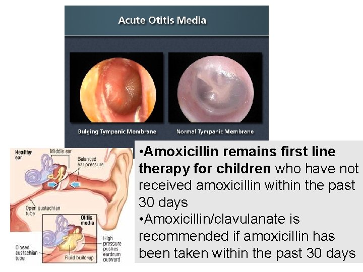  • Amoxicillin remains first line therapy for children who have not received amoxicillin