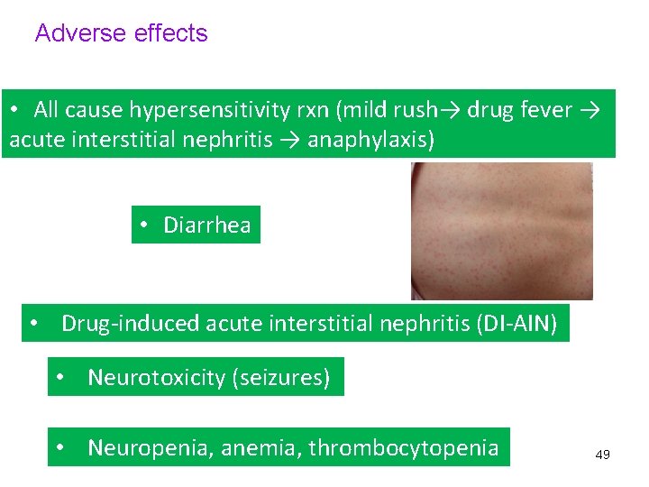 Adverse effects • All cause hypersensitivity rxn (mild rush→ drug fever → acute interstitial