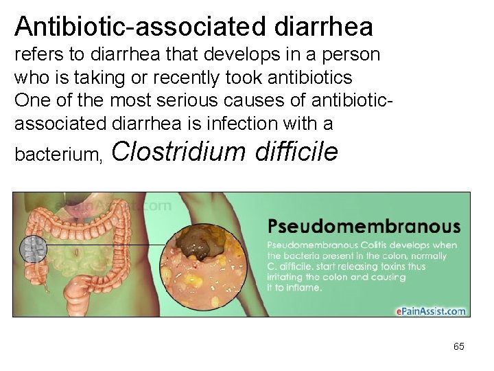 Antibiotic-associated diarrhea refers to diarrhea that develops in a person who is taking or