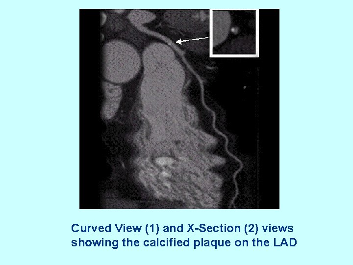 Curved View (1) and X-Section (2) views showing the calcified plaque on the LAD