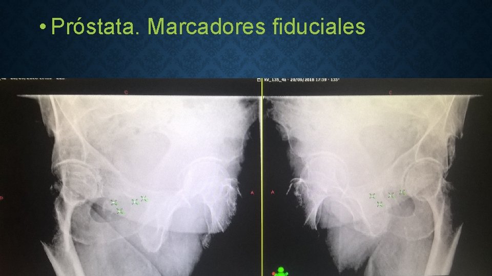  • Próstata. Marcadores fiduciales 