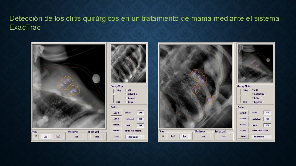 Detección de los clips quirúrgicos en un tratamiento de mama mediante el sistema Exac.