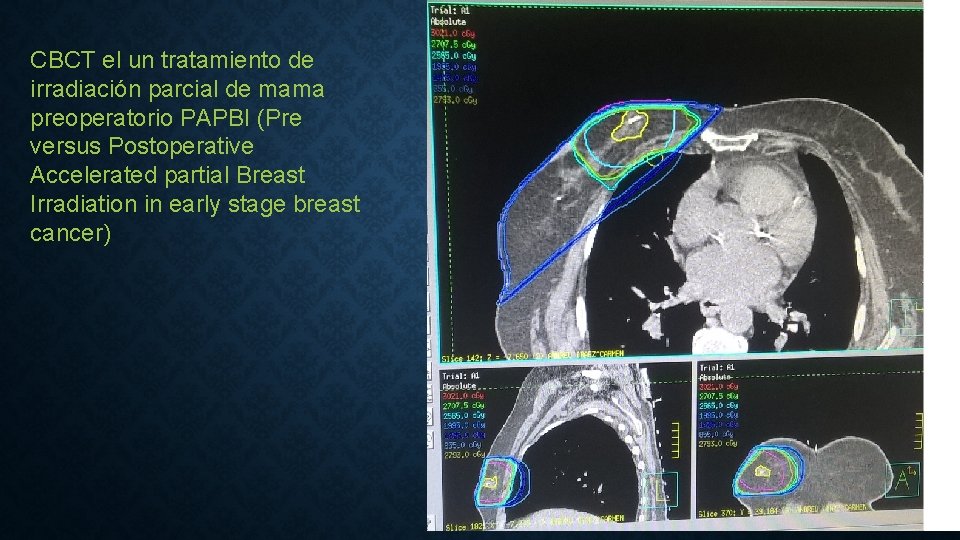 CBCT el un tratamiento de irradiación parcial de mama preoperatorio PAPBI (Pre versus Postoperative