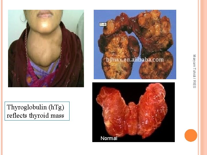 Maryam Tohidi / RIES Thyroglobulin (h. Tg) reflects thyroid mass Normal 