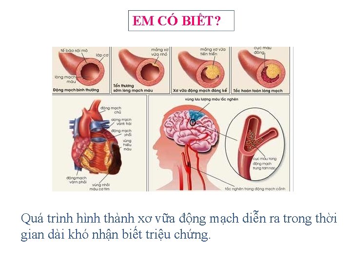 EM CÓ BIẾT? Quá trình hình thành xơ vữa động mạch diễn ra trong