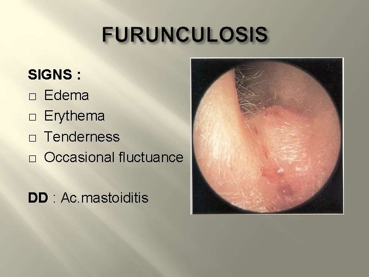 SIGNS : � Edema � Erythema � Tenderness � Occasional fluctuance DD : Ac.