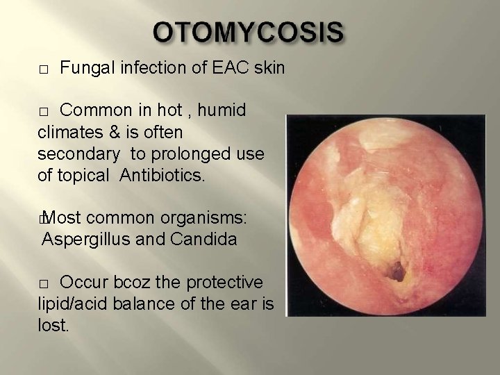 � Fungal infection of EAC skin Common in hot , humid climates & is