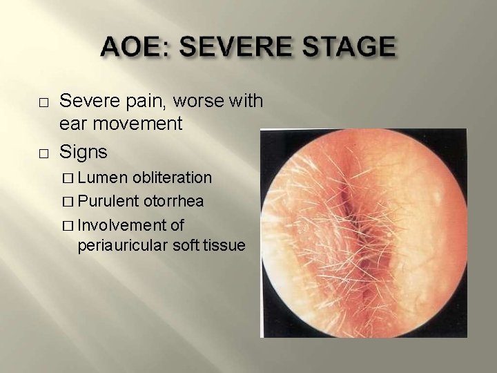 � � Severe pain, worse with ear movement Signs � Lumen obliteration � Purulent