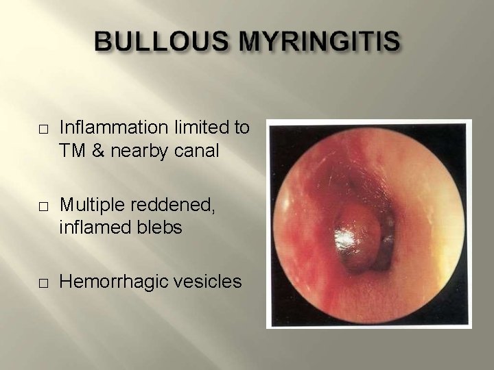 � � � Inflammation limited to TM & nearby canal Multiple reddened, inflamed blebs