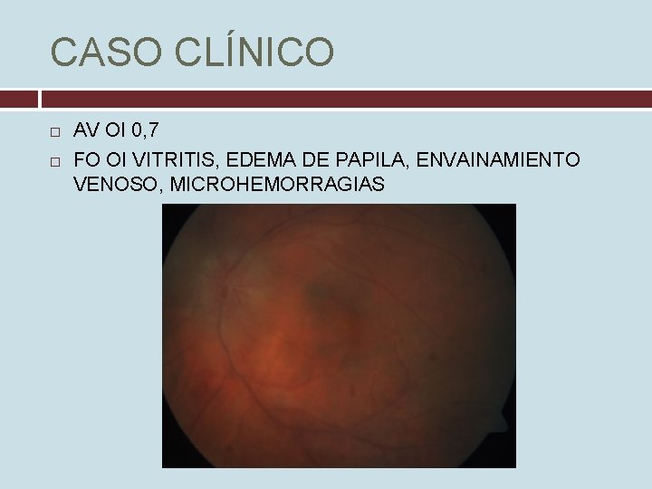 CASO CLÍNICO AV OI 0, 7 FO OI VITRITIS, EDEMA DE PAPILA, ENVAINAMIENTO VENOSO,