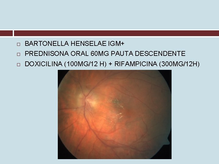  BARTONELLA HENSELAE IGM+ PREDNISONA ORAL 60 MG PAUTA DESCENDENTE DOXICILINA (100 MG/12 H)