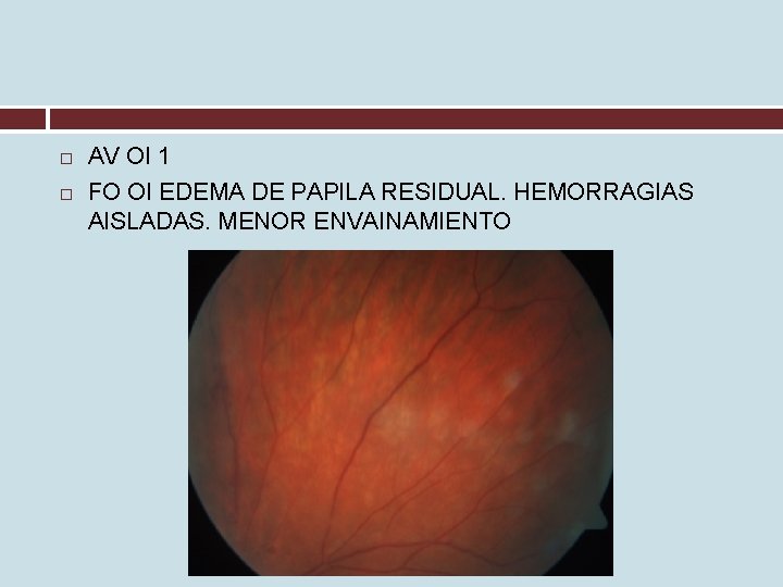  AV OI 1 FO OI EDEMA DE PAPILA RESIDUAL. HEMORRAGIAS AISLADAS. MENOR ENVAINAMIENTO