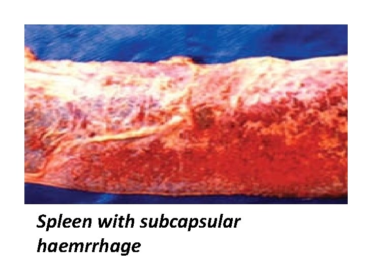 Spleen with subcapsular haemrrhage 