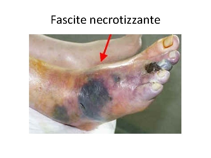 Fascite necrotizzante 