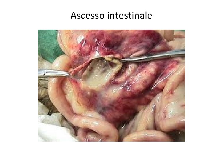 Ascesso intestinale 