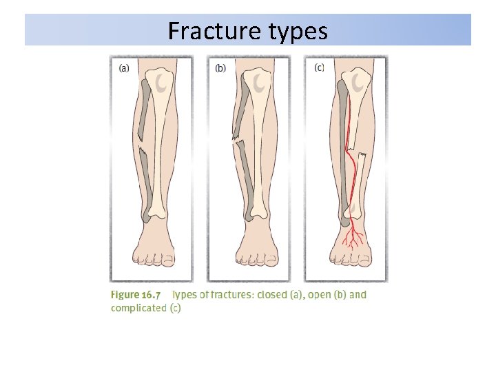 Fracture types 