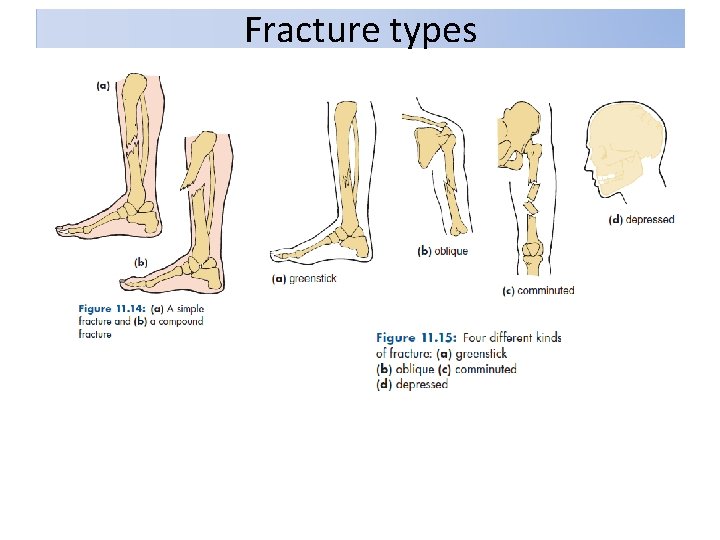Fracture types 