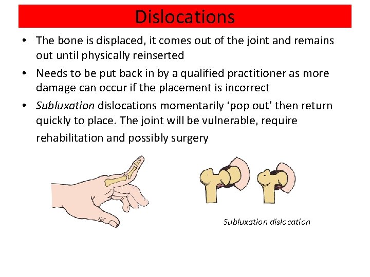 Dislocations • The bone is displaced, it comes out of the joint and remains
